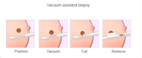 breast biopsy how to a breast biopsy test that