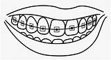 Braces Teeth Coloring Clipart Smile Pages Mouth Template Collection Drawing Transparent Cigar Tooth Webstockreview Clipground Pngitem Dental sketch template