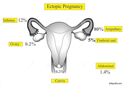 ectopic pregnancy   diagnosis labpedianet