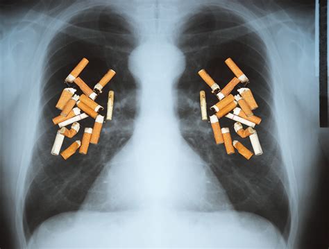 ct test for hidden lung cancer is cost effective but not covered for