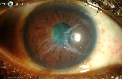 lattice corneal dystrophy the university of iowa ophthalmology