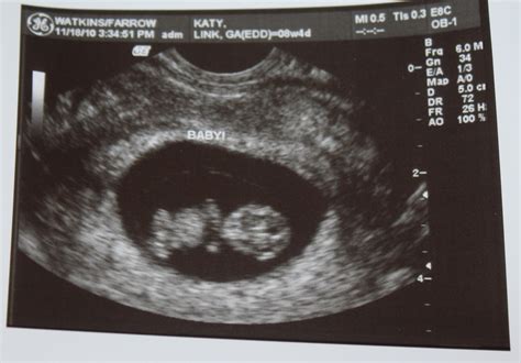weeks  days pregnant ultrasound wwwpixsharkcom images