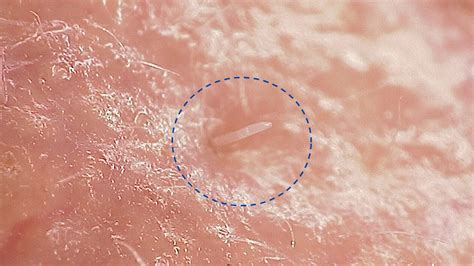 demodex mites  skin health understanding symptoms  treatment