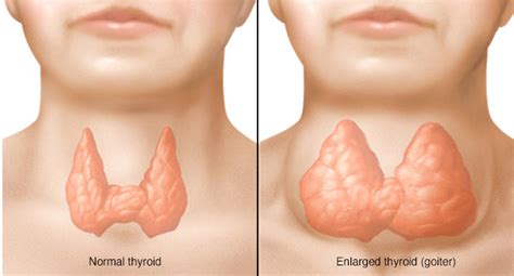 goiter  symptoms treatment diagnosis diet  thyroid