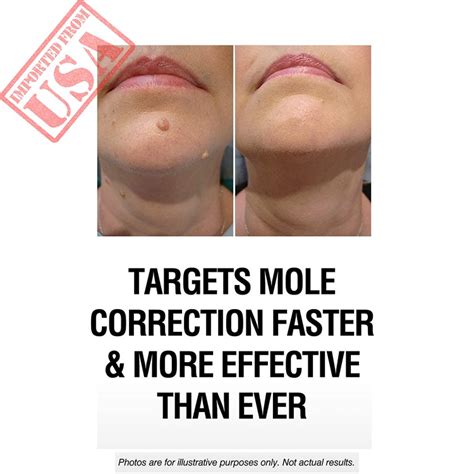 skinpro extreme skin tag remover and mole corrector fast