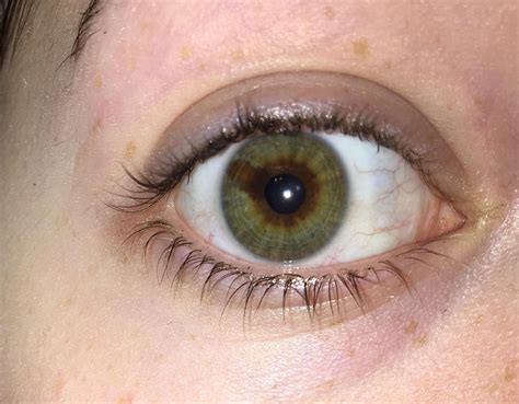 brown    green   eye    sectoral heterochromia sectoral
