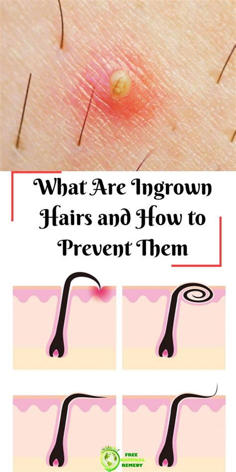How To Get Rid Of Ingrown Hair Causes Tips And Home
