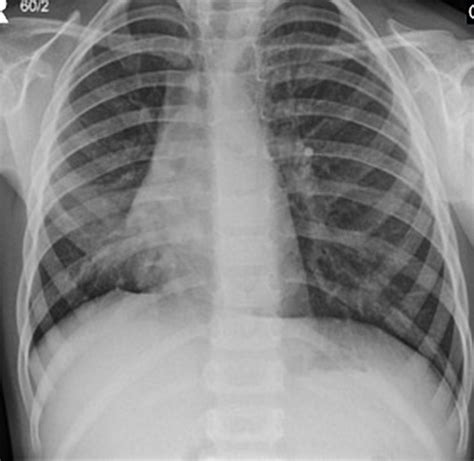 Right Middle Lobe Atelectasis Pacs