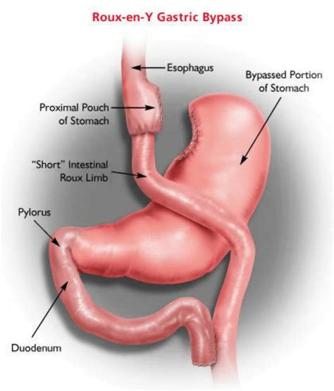 Roux En Y Gastric Bypass Illustration Download
