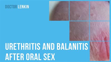 Urethritis And Balanitis After Oral Sex Youtube