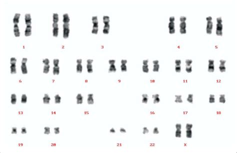 A Normal Female Karyotype Showing 46 Xy Download Scientific Diagram