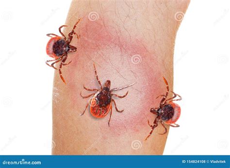 tick  human leg dangerous parasite  human skin stock photo image  lyme mosquito