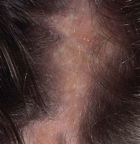 causes of folliculitis on scalp my xxx hot girl