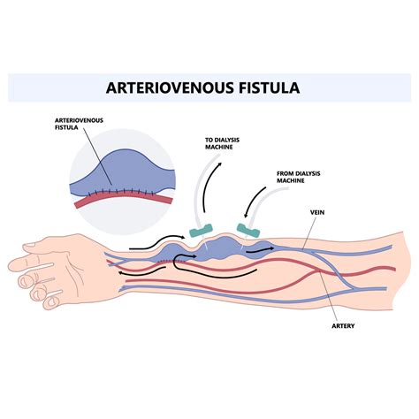 arteriovenous fistula vejthani hospital jci accredited