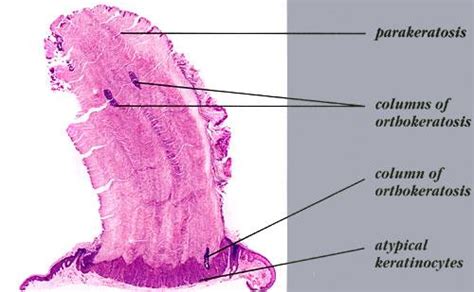 verrucous solar keratosis altkran aldyaey almtthall