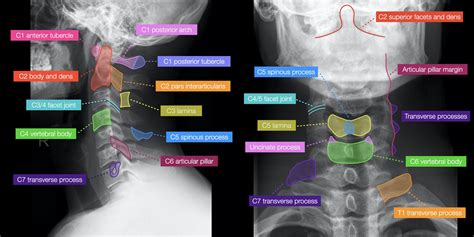 cervical spine xray anatomy ap  lateral radiopaediaorg grepmed