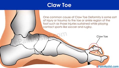 claw toetreatmentcausessymptomspreventioncomplications