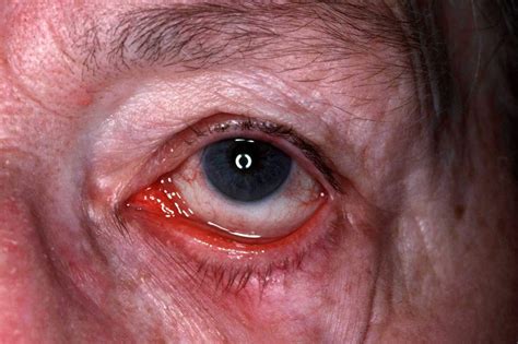 ocular rosacea  triggers symptoms eye drops treatment