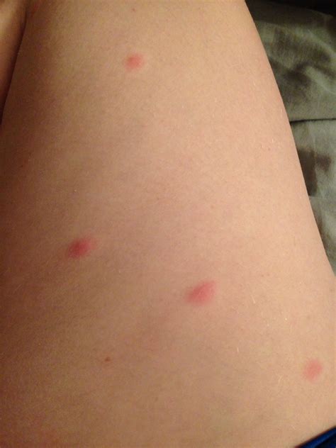 Noticed A Few Small Itchy Bumps On My Thighs Late Last