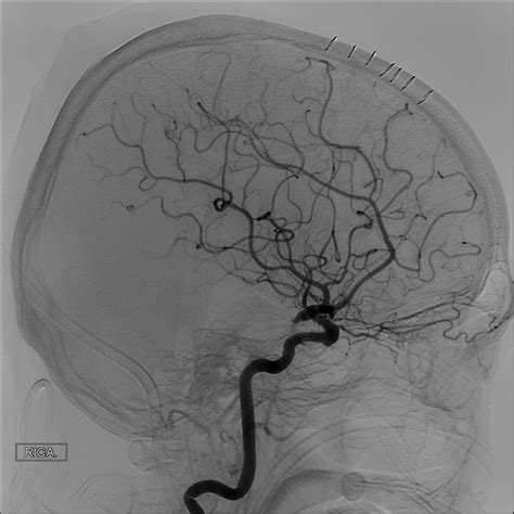 cerebral aneurysm angiogram
