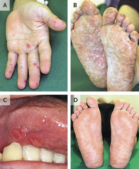 hand foot  mouth disease   adult nejm