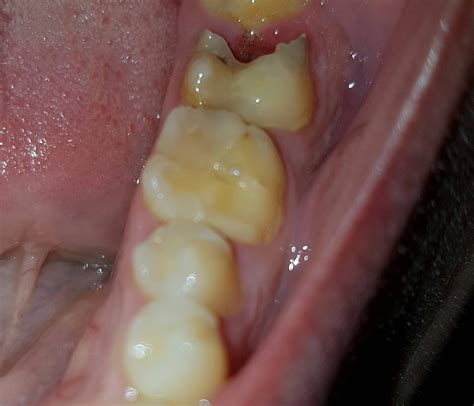 molar broke     repaired     tooth