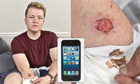 iphone 5 scars teen for life after phone burns hole on his arm daily mail online