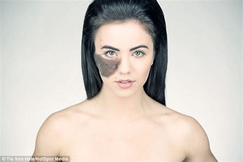 Cassandra Naud With Huge Birthmark On Her Face Refuses Surgery Daily