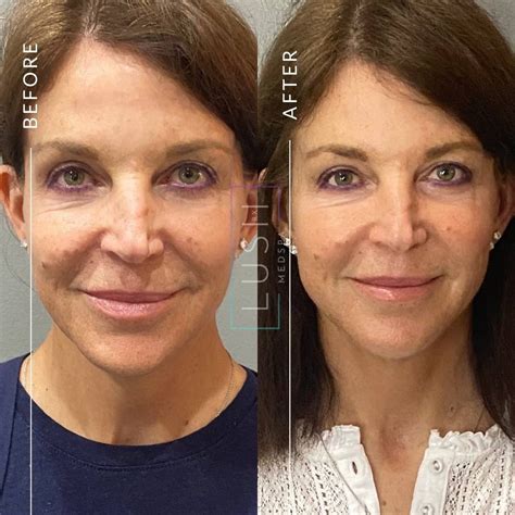 pdo threads  surgical facelift houston tx lush rx med spa