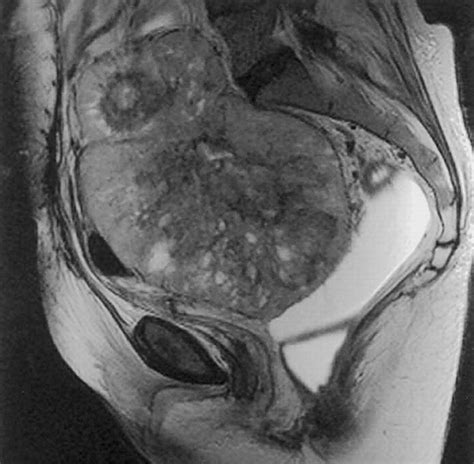 Mr Imaging Of Common And Uncommon Large Pelvic Masses Radiographics