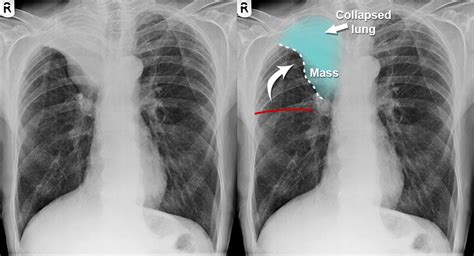 Chest X Ray Lung Cancer Lobar Collapse