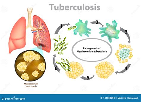 tuberculosis cartoon vector cartoondealercom