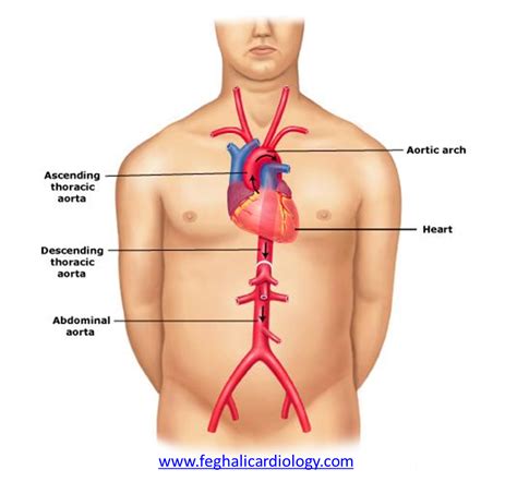 aorta taad genetic aortic disorders association canada