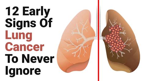 12 early signs of lung cancer to never ignore