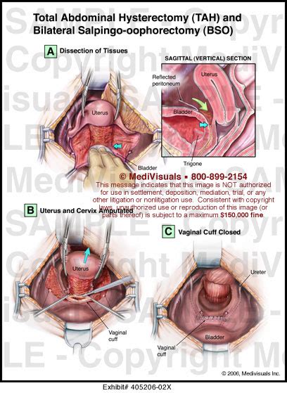 medivisuals total abdominal hysterectomy tah and