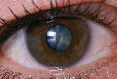 stem cells revolutionize cataract surgery eyedolatry