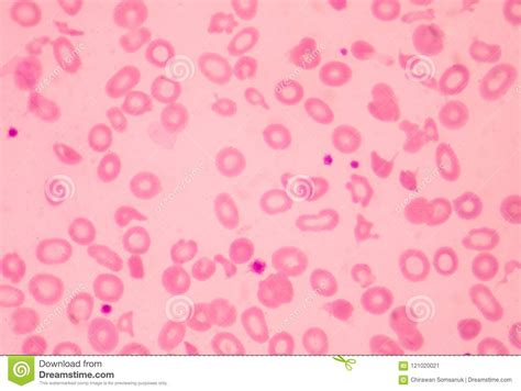 thalassemia blood smear abnormal red blood cells morphology stock