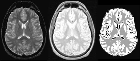 sex differences in brain gray and white matter in healthy