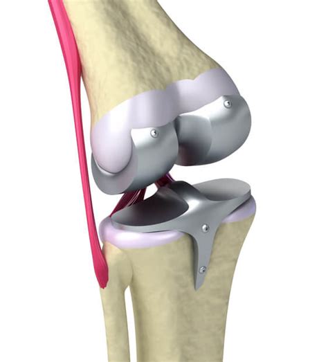 Knee Replacement Implant Types Revision Surgery And Recalls