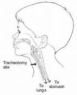 Tracheostomy Care sketch template