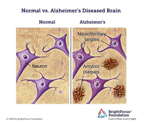 apoe diet  alzheimers disease explained  human terms
