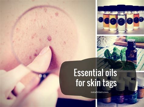 best essential oils for skin tags removal 3 top recipes
