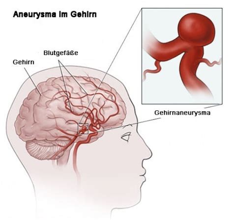 aneurysma vorsorge und anzeichen besser gesund leben