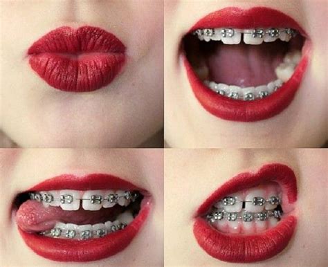 enjoy your braces journey watch your smile go from
