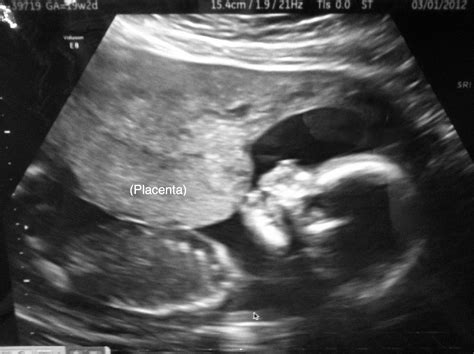 pregnancy update fetal echo gender reveal
