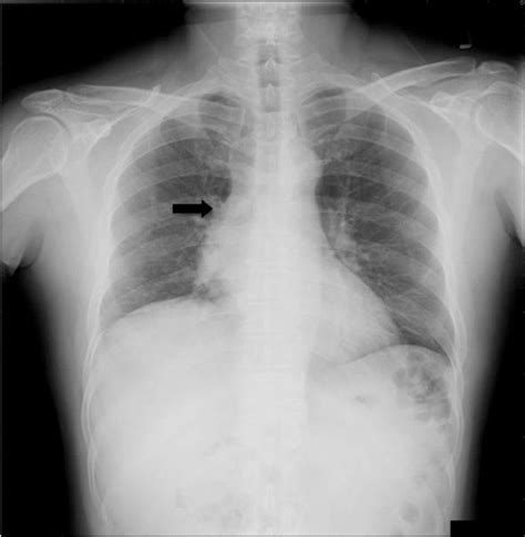 Chest X Ray Indicating Enlargement Of The Right Hilar Area And