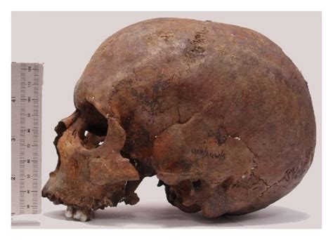 The Cranium Of An Adult Male Recovered From The River Witham Lincoln