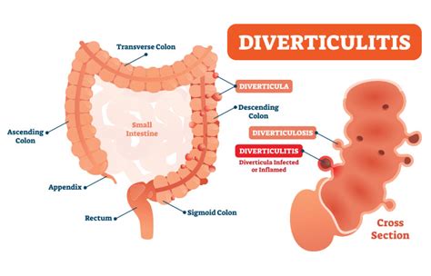 diverticulitis symptoms causes and treatment diet