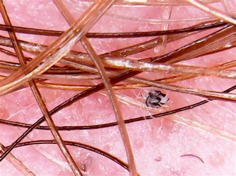 New Book Reveals Truth Behind Morgellons Disease