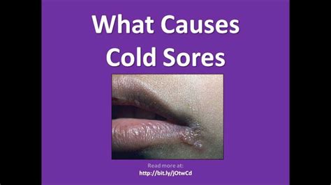 best cold sore remedies treatment cure fever blisters youtube